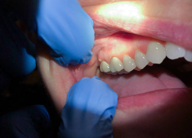 Best Emergency Dentist for Lost Fillings or Crowns in Roseland, FL