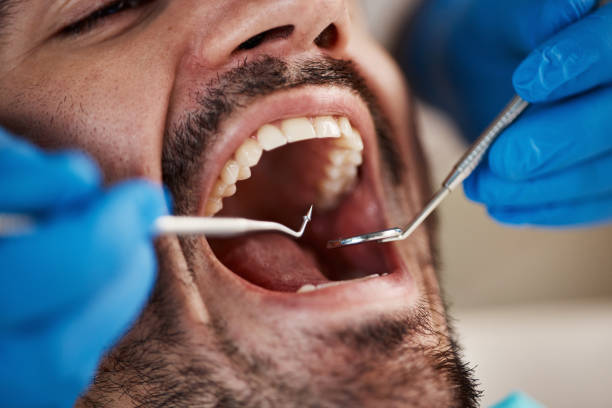 Best Emergency Dentist for Lost Fillings or Crowns in Roseland, FL
